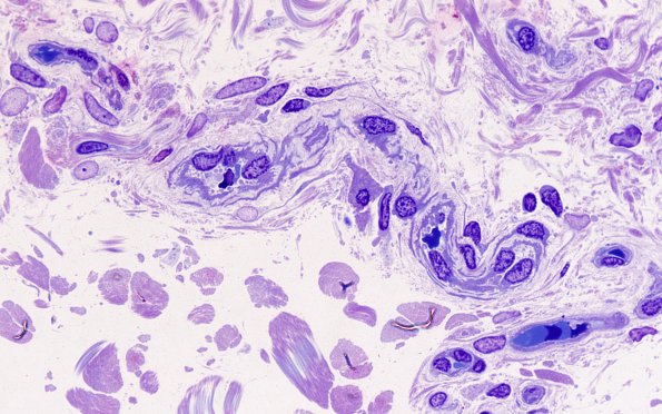 11D5 CADASIL (Case 11) E block 100X 4