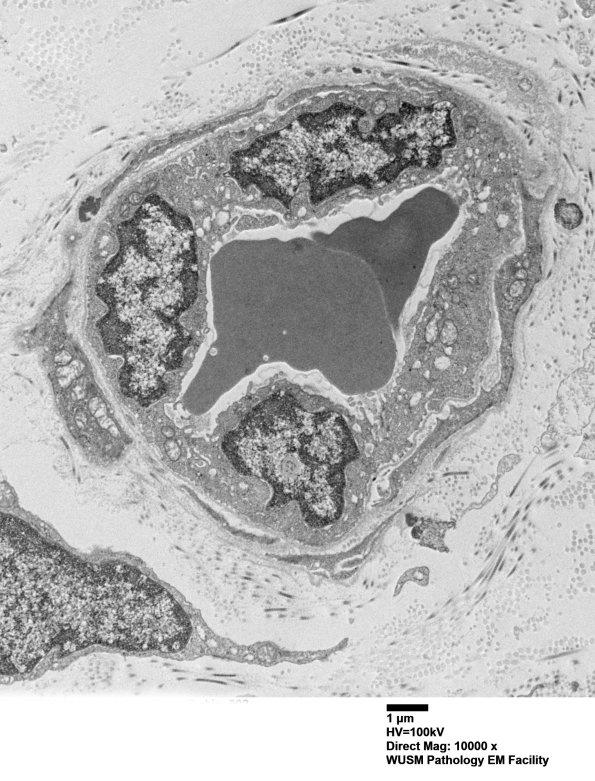 11E1A (Case 11) BlkD skin EM 002 - Copy