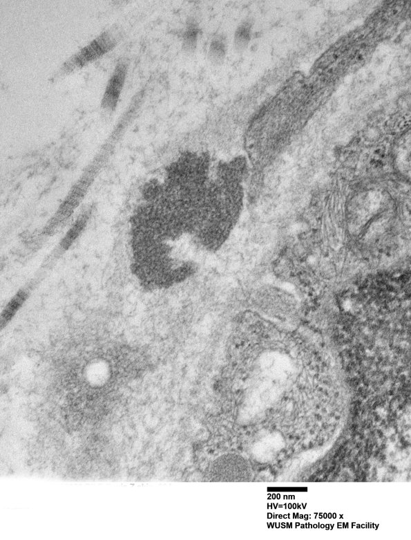 11E1C (Case 11) BlkD skin EM 004 - Copy