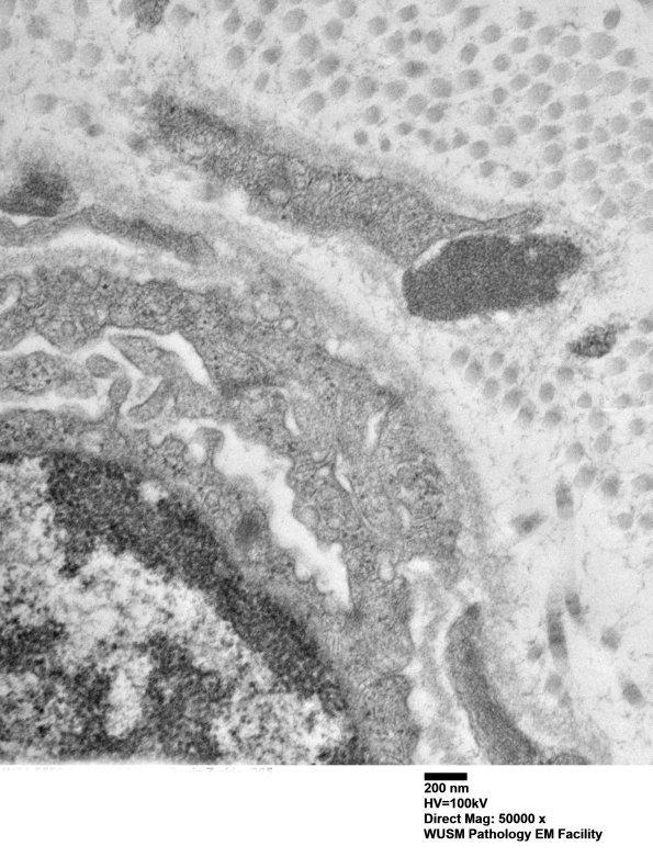 11E2B (Case 11) BlkD skin EM 005 - Copy