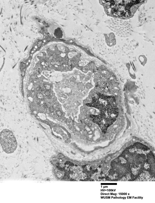 11E3A (Case 11) BlkD skin EM 008 - Copy