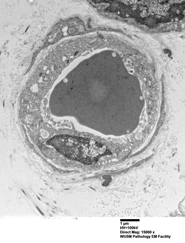 11E4A (Case 11) BlkD skin EM 010 - Copy