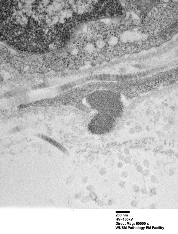 11E4B (Case 11) BlkD skin EM 011 - Copy