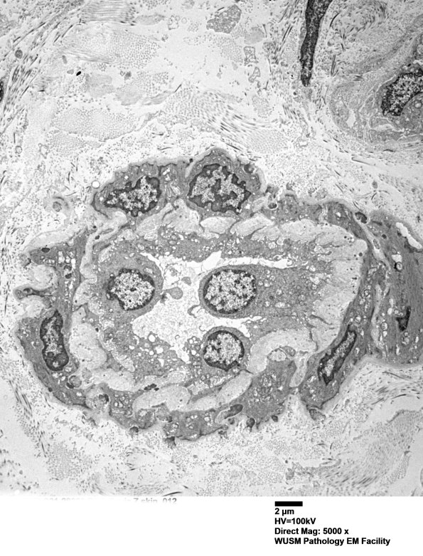 11E5A (Case 11) BlkD skin EM 012 - Copy