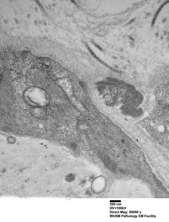 11E5C (Case 11) BlkD skin EM 015 - Copy