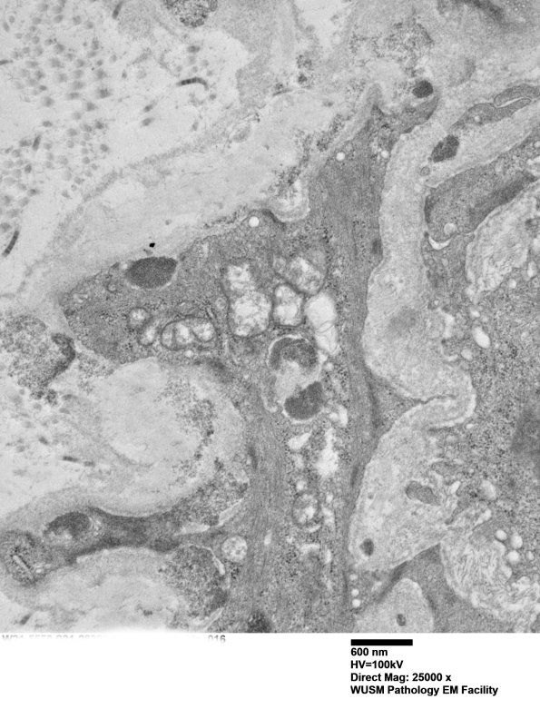 11E5E (Case 11) BlkD skin EM 016 - Copy