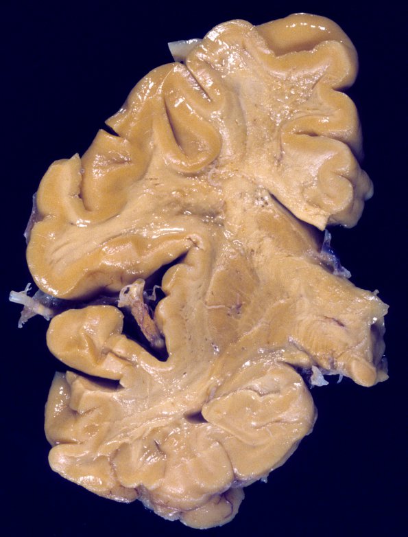 1A2 CADASIL (Case 1) gross 3