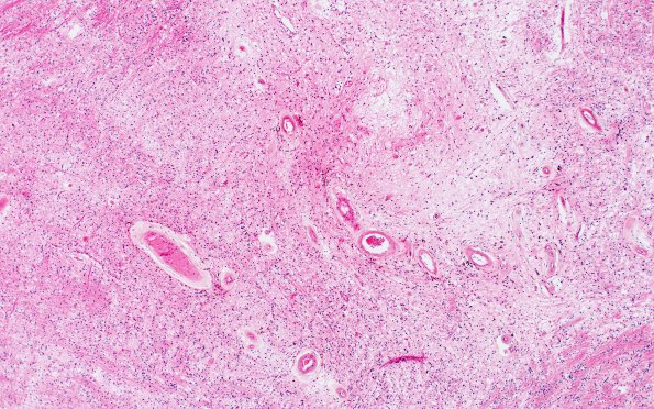 1C1 CADASIL (Case 1) H&E 4X