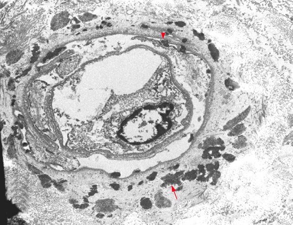 1J1 CADASIL (Case 1) - Copy