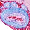 2C3 CADASIL (Case 2) Trichrome 3