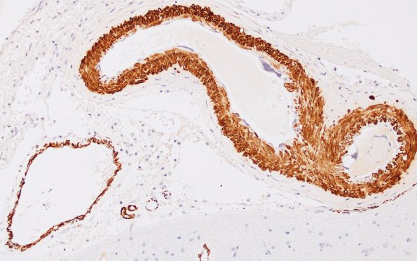 2D1 Normal vessels (Case 11) SMA 20X