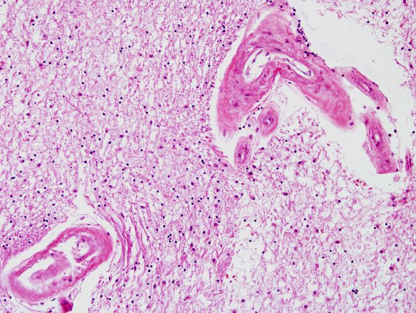 3C4 CADASIL (Case 3) Slide C, Area A H&E