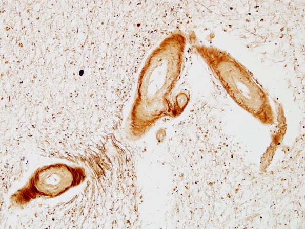 3C6 CADASIL (Case 3) Slide C, Area A Biels