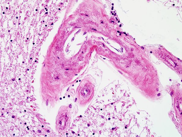 3D1 CADASIL (Case 3) Slide C H&E 