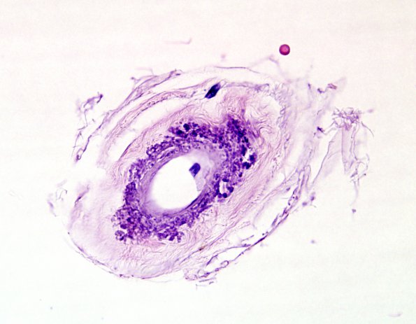 3D7 CADASIL (Case 3) H&E 5 (2)