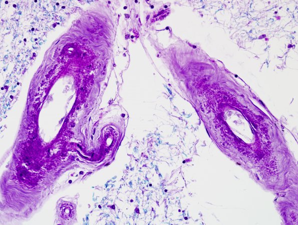 3E2 CADASIL (Case 3) Slide C LFB-PAS 7