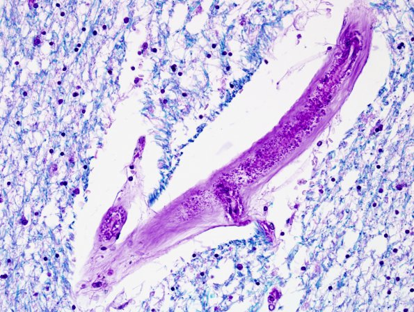 3E5 CADASIL (Case 3) Slide C LFB-PAS 6.