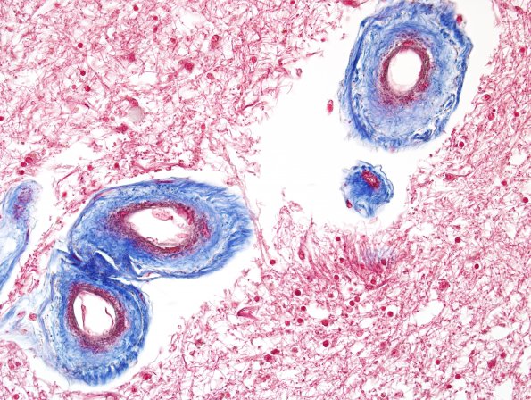 3G1 CADASIL (Case 3) Trichrome 3