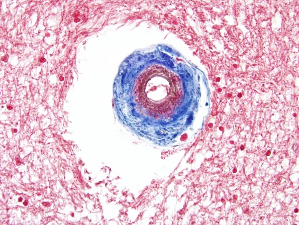 3G2 CADASIL (Case 3) Trichrome 1