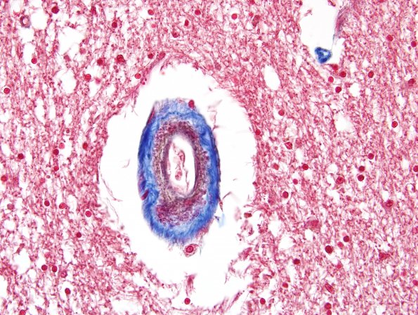 3G3 CADASIL (Case 3) Trichrome 4