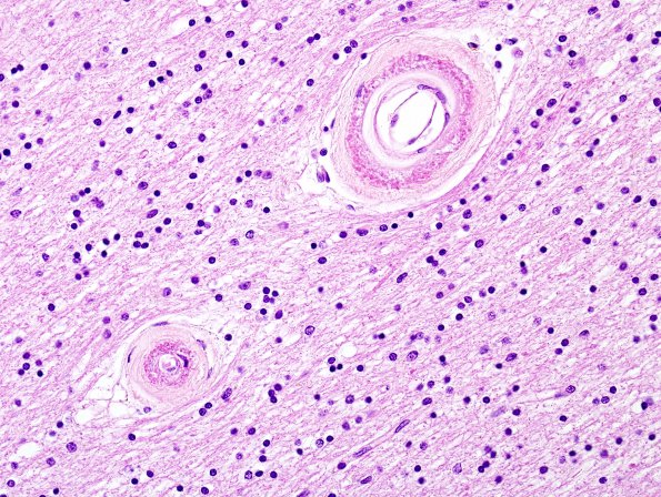 5B2 CADASIL (Case 5) H&E 8