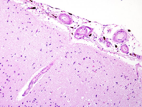 5B3 CADASIL (Case 5) H&E 4