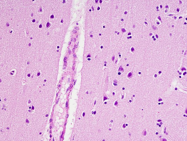 5B4 CADASIL (Case 5) H&E 3