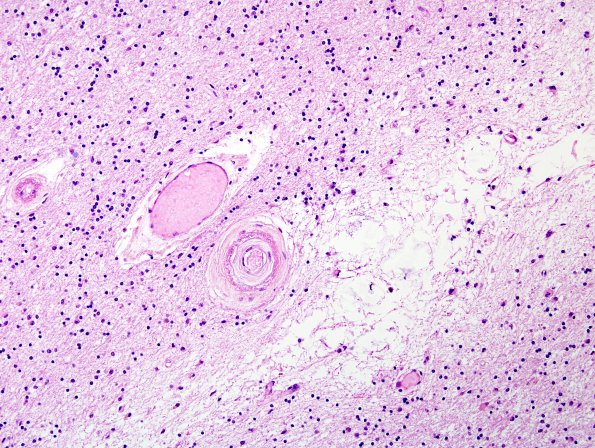 5B5 CADASIL (Case 5) H&E 9