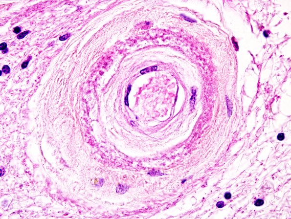 5B7 CADASIL (Case 5) H&E 13