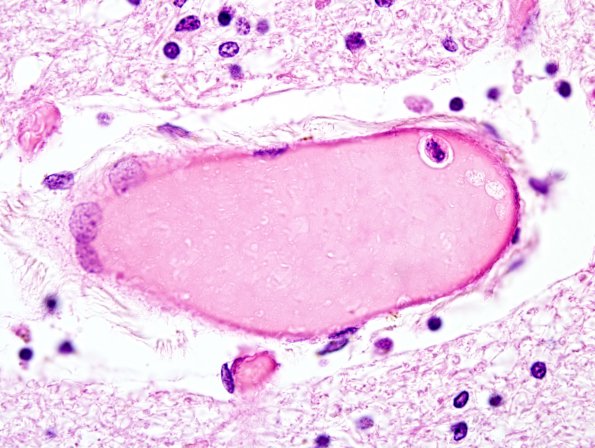 5B8 CADASIL (Case 5) H&E 11