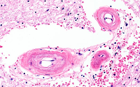 6C3 CADASIL (Case 6) N4 H&E 40X 2