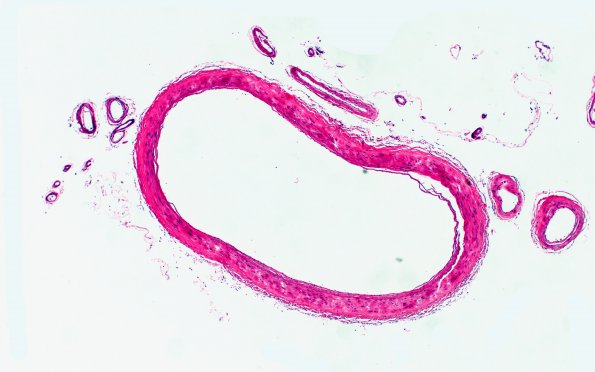 6C4 CADASIL (Case 6) N20 H&E