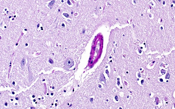 6D3 CADASIL (Case 6) N4 LFB-PAS 40X 3