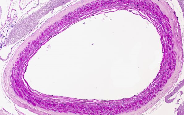 6D4 CADASIL (Case 6) N4 LFB-PAS 10X