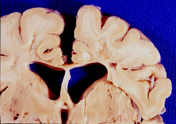 8A2 CADASIL  (AANP 1994, Case 8)  1