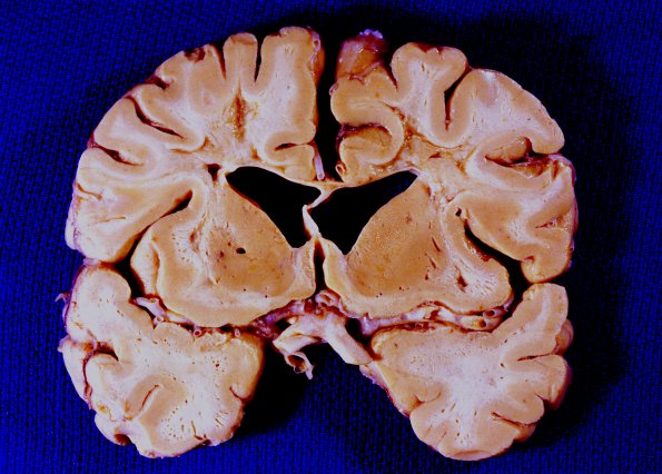 8A3 CADASIL (AANP 1994, Case 8) 2