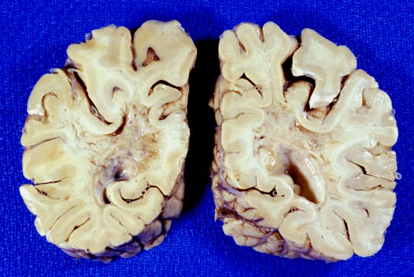 8A4 Seidman  (AANP 1994, Case 8) 1a