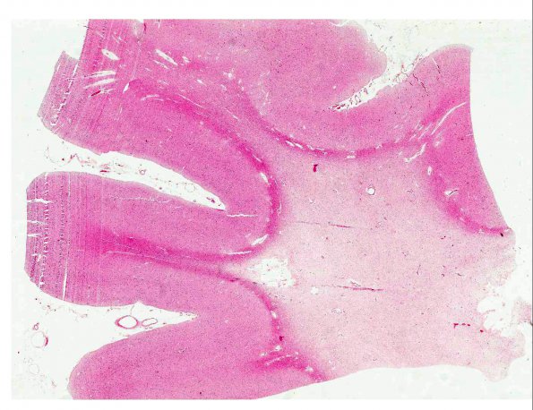 8B1 CADASIL (AANP 1994, Case 8) H&E X0.5