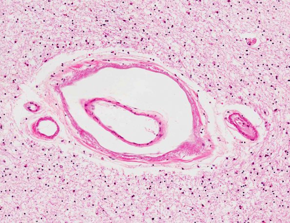 8B5 CADASIL (AANP 1994, Case 8) H&E X14