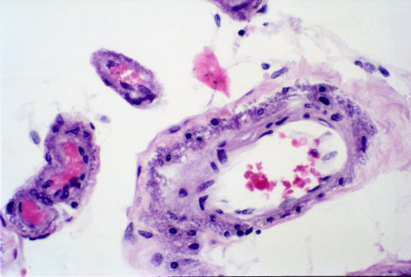 9B1 CADASIL (Case 9) H&E 3