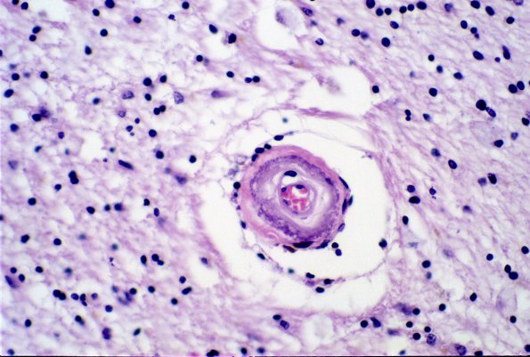 9B2 CADASIL (Case 9) H&E 2