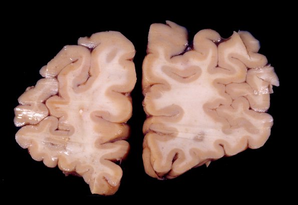 10A1 Cerebroretinal Vasculopathy, CRV, RVCL, TREX, HERNS, Case 10) 6