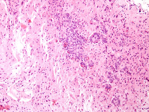 11A1 Cerebroretinal Vasculopathy, CRV, RVCL, TREX, HERNS, Case 11, Neurosurgical) H&E 4