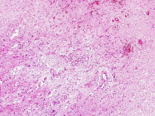 11A2 Cerebroretinal Vasculopathy, CRV, RVCL, TREX, HERNS, Case 11, Neurosurgical) H&E 7