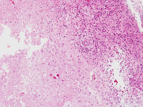 11A3 Cerebroretinal Vasculopathy, CRV, RVCL, TREX, HERNS, Case 11, Neurosurgical) H&E 1