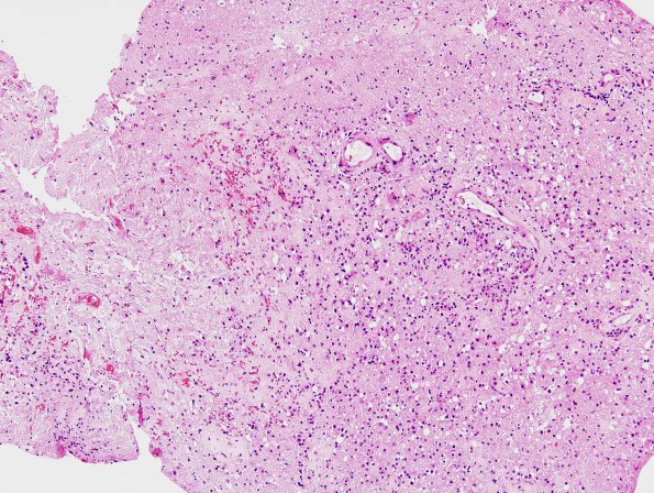 11A4 Cerebroretinal Vasculopathy, CRV, RVCL, TREX, HERNS, Case 11, Neurosurgical) H&E 2