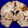 11B1 Cerebroretinal Vasculopathy, CRV, RVCL, TREX, HERNS, Case 11, Autopsy) 1