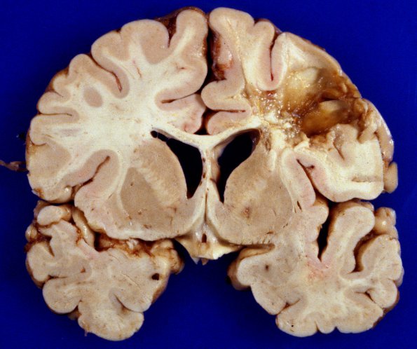 11B1 Cerebroretinal Vasculopathy, CRV, RVCL, TREX, HERNS, Case 11, Autopsy) 1