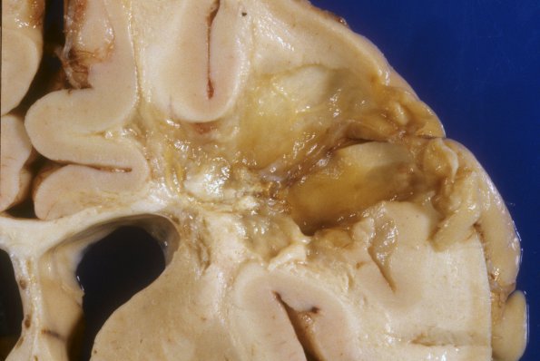 11B2 Cerebroretinal Vasculopathy, CRV, RVCL, TREX, HERNS, Case 11, Autopsy)  A1