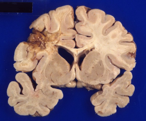 11B3 Cerebroretinal Vasculopathy (CRV, RVCL, TREX, HERNS, Case 11, Autopsy) 2